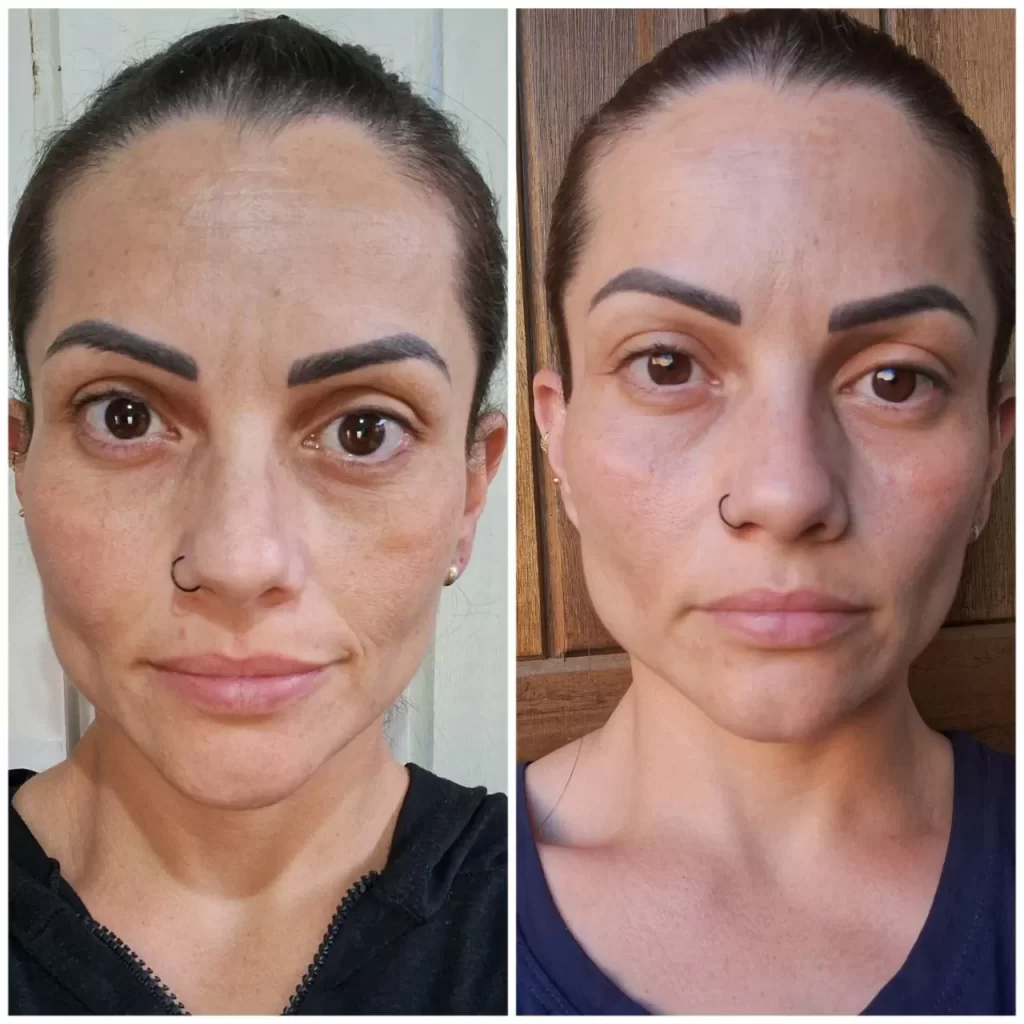 Antes e Depois Nutral Fit Clareador Resultado 1