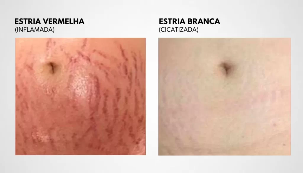 Diferença entre estrias vermelhas e brancas